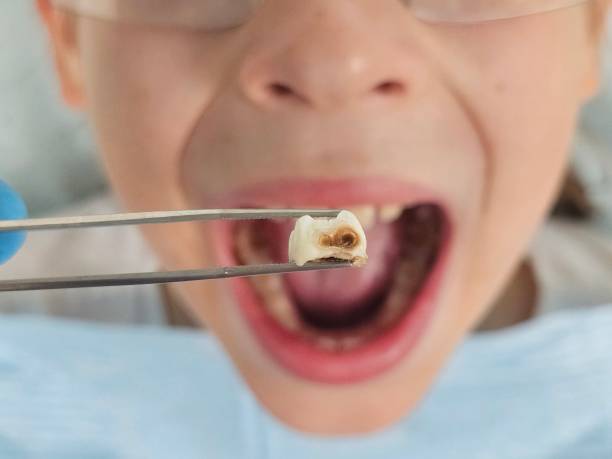 Best Broken or Chipped Tooth Repair in Rainsville, AL