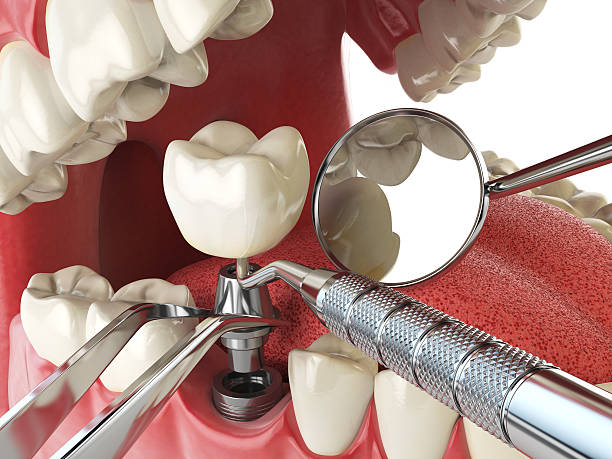 Best Emergency Wisdom Tooth Extraction in Rainsville, AL